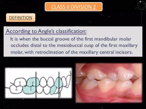 Class ii div 2 malocclusion | PPTX
