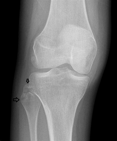 Avulsion fracture of the proximal fibula (arcuate sign) in a young ...