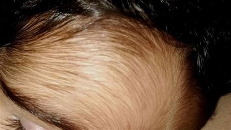 Sigue abierta la causa por el crecepelo en el omeprazol suministrado a ...