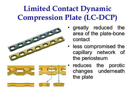 Limited Contact Dynamic Compression Plate 的图像结果