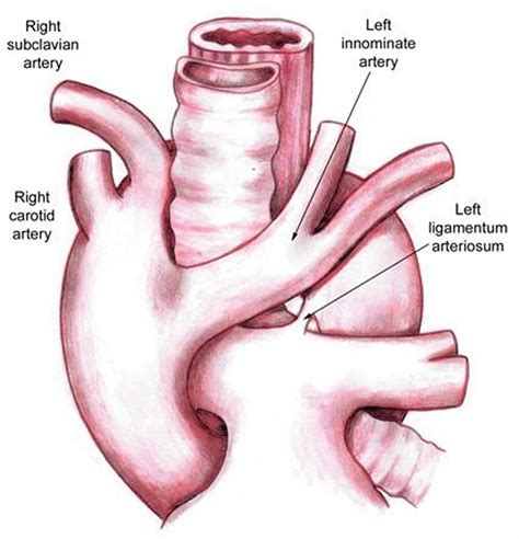 Vascular ring causes, symptoms, diagnosis, treatment & prognosis