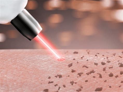 Inurskn's Renowned Hollywood Facial and Carbon Laser Treatment in Mumbai