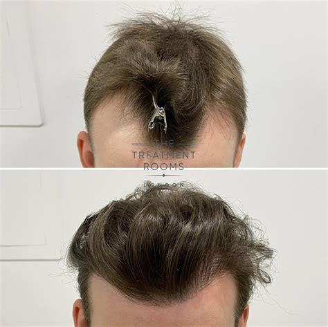 Mature vs. Receding Hairline | Treatment Rooms London