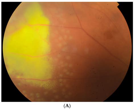 Children | Special Issue : New Insights in Pediatric Optometry and ...