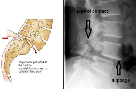SPONDYLOLISTHESIS EXERCISES, CAUSES, SYMPTOMS, TREATMENT