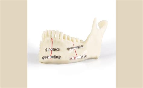 iDENTical Jaw with Titanium Plate Model M5001 | Educational Tool for ...