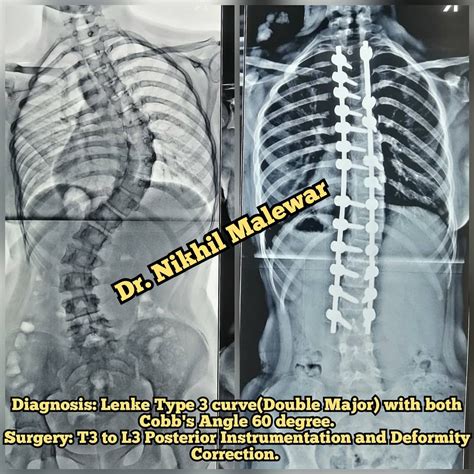 Scoliosis and Kyphosis Surgery - Dr. Nikhil Malewar
