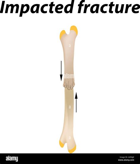 Impacted fracture Bone. Infographics. Vector illustration on a lined ...
