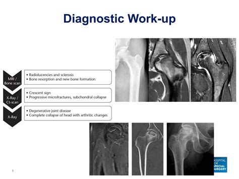 Bone Marrow Lesions of the Hip - Avascular Necrosis and Subchondral ...