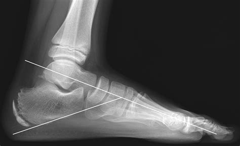 Normal Foot 的图像结果