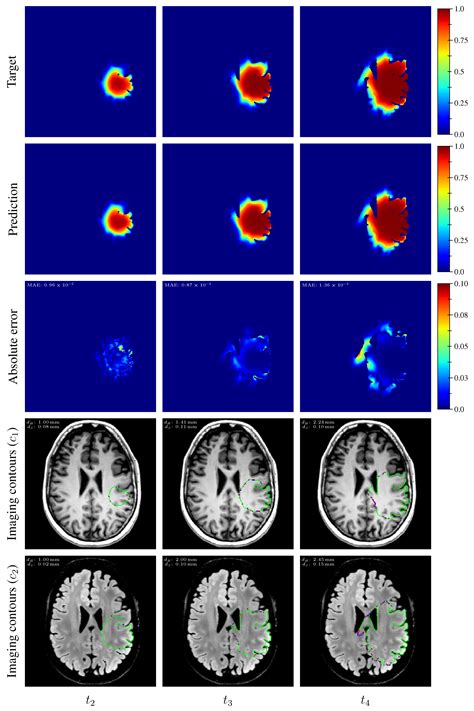 Deep Learning for Reaction-Diffusion Glioma Growth Modeling: Towards a ...