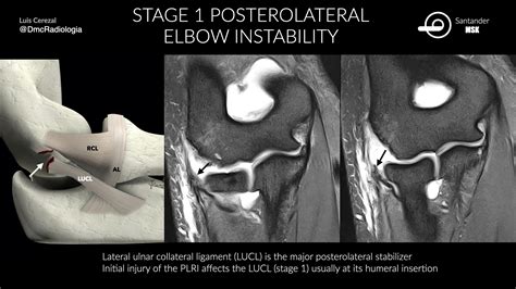 Medial Collateral Ligament Elbow Mri