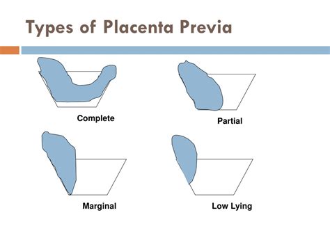 PPT - OBSTETRIC Hemorrhage (APH &PPH) PowerPoint Presentation, free download - ID:9111537