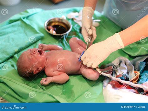 Cutting The Umbilical Cord Between A Newborn Baby And Placenta. Royalty-Free Stock Photography ...