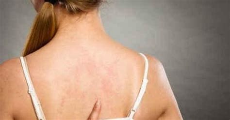 发痒|为什么背部经常会发痒？这3个原因，一说一个准 原因|发痒|后背|
