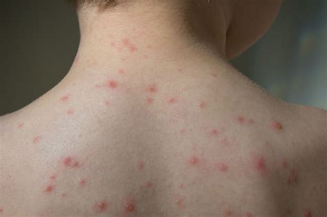 Chicken Pox Virus Chickenpox: What Is It? Why Is It Spreading At The