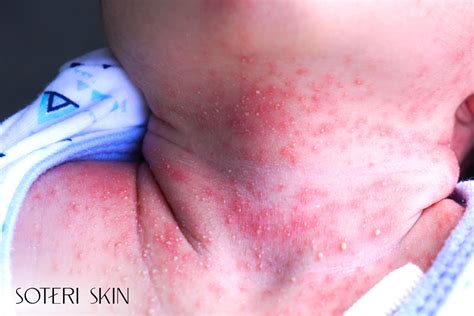 Heat Rash: Symptoms, Types, Causes & Skin Relief Guide