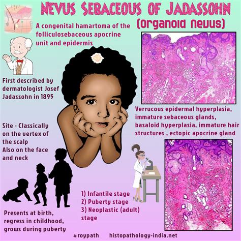 Pathology of Nevus Sebaceus of Jadassohn | Pathology, Sebaceous gland ...