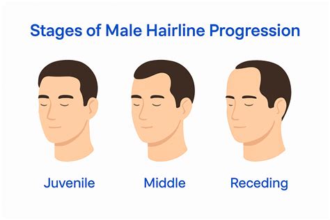 Normal Hairline for Men: What It Looks Like | MyHair