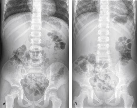 Nonobstructive Bowel Gas Pattern
