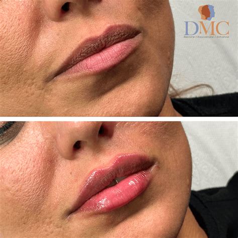 Image result for Derma Procedure