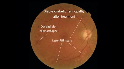 Proliferative Diabetic Retinopathy Neovascularization
