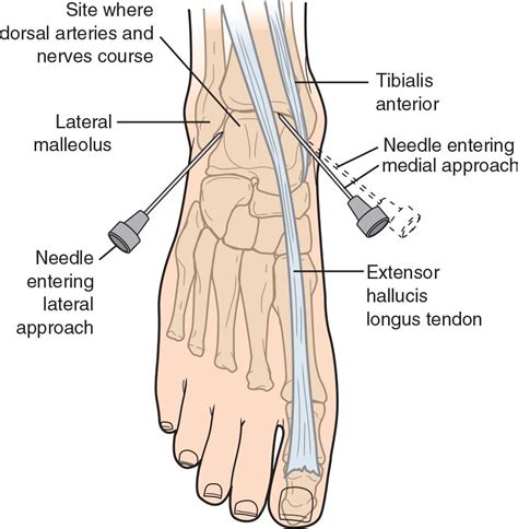 Image result for Ankle Injection Procedure