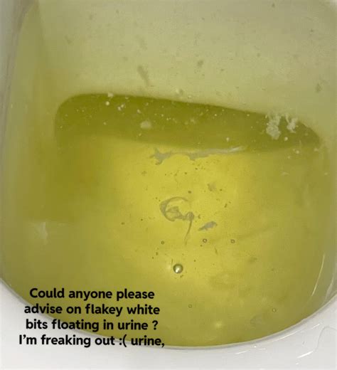 1 best r/kidney images on Pholder | White flaky floaty bits in urine, please advise