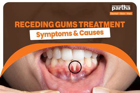 Receding Gums Treatment – Symptoms, Causes & Best Solutions | Partha Dental