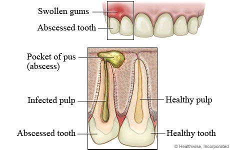 Image result for Abscessed Tooth Explosion