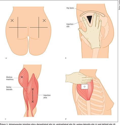 Ventrogluteal