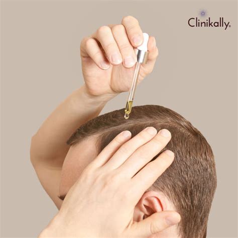 Topical Finasteride: Benefits, How to Use, Side Effects