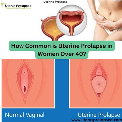 What is a Stage 4 Uterine Prolapse?