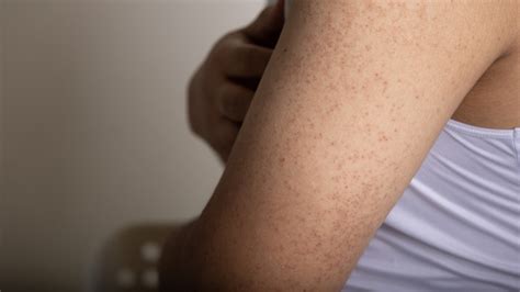 Dark Spots After Waxing? Here Is How You Can Prevent Hyperpigmentation ...