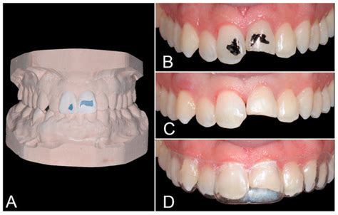 Anterior Esthetic Restorations with the Stratified Stamp Technique: A ...