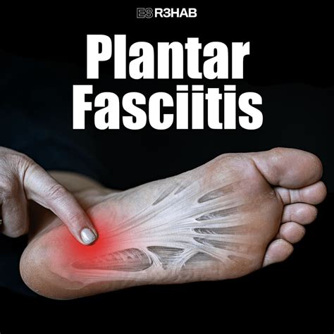 Plantar Fasciitis - E3 Rehab