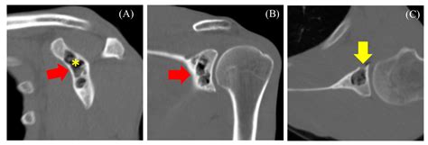 Subchondral Cyst Shoulder