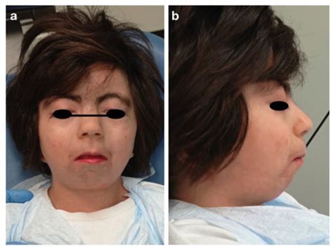 Rare Genetic Syndromes and Oral Anomalies: A Review of the Literature ...