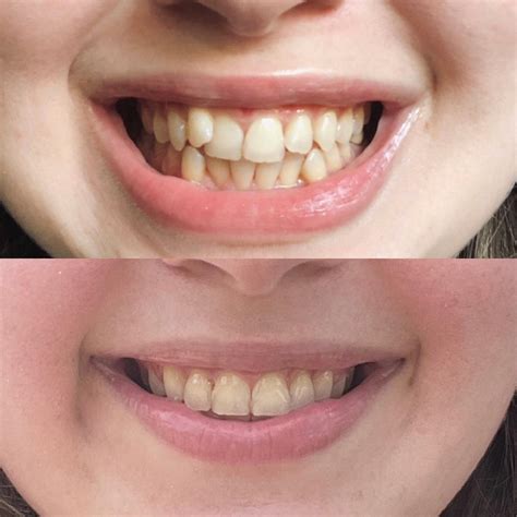 I Got Braces at 60 Years Old, and My Smile’s Never Looked Better HD Wallpaper