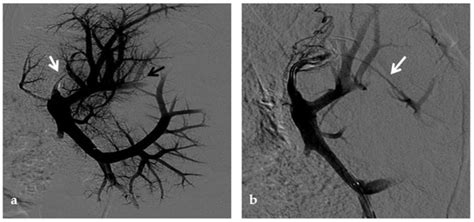 The Role of Imaging in Portal Vein Thrombosis: From the Diagnosis to ...