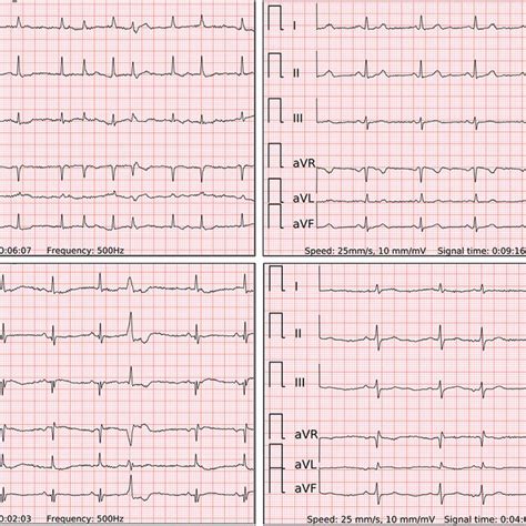 Image result for Counterclockwise Atrial Flutter