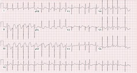 Image result for AFib Detection Algorithm