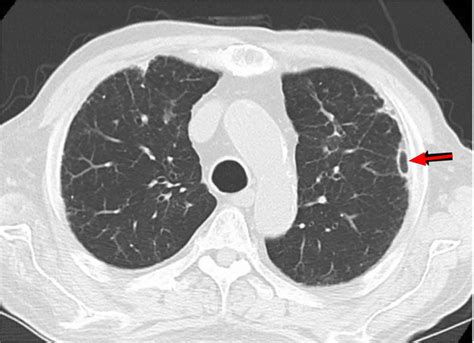 What Diseases Cause Lung Nodules at Arthur Hanley blog