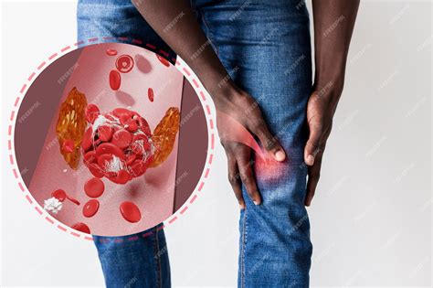 Enfermedad de los coágulos de sangre en las piernas. | Foto Premium