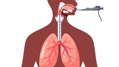 Windpipe Narrowing Causes: Comprehensive Airway Evaluation and ...