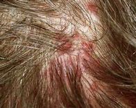 頭皮湿疹 に対する画像結果
