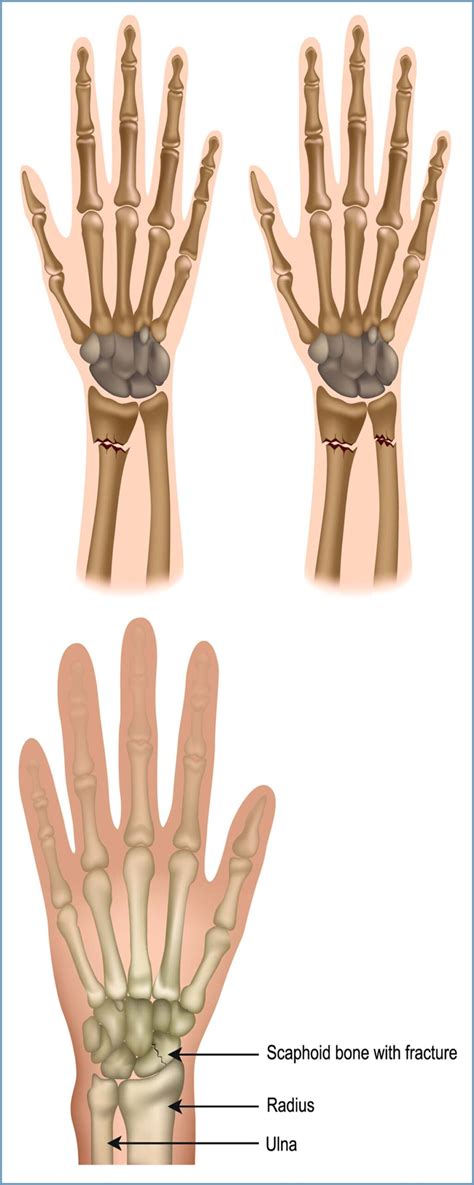 Distal Radius, Scaphoid (Wrist Fractures) - Yellowstone Surgery Center