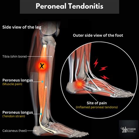 Fibularis Longus Tendon Diagnosis And Treatment Of Peroneal Tendon