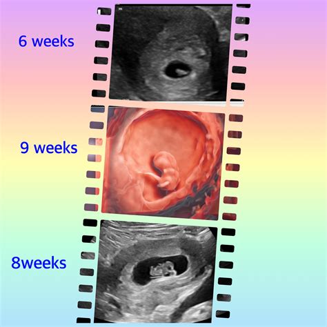 3D 4D 5D HD baby ultrasound imaging. Gender Ultrasound Sonogram. Bebe ...