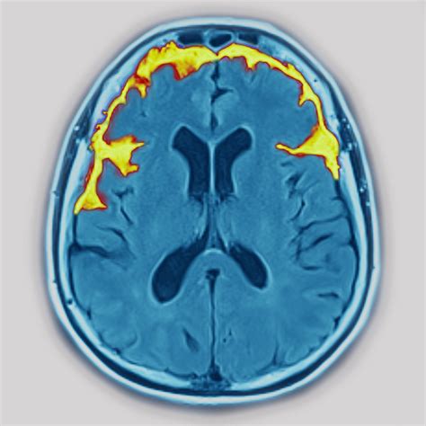 What Causes Dementia